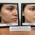 Microneedling Before and After