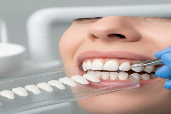 Dental Veneers for Missing Teeth
